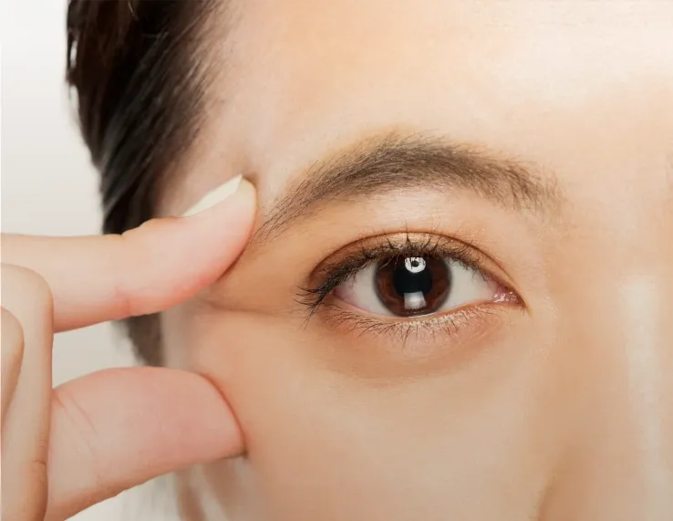 Blepharoplasty procedure